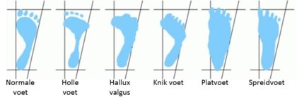 Voetklachten Voetklachten