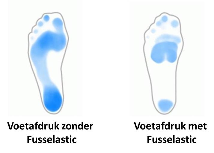 steunzolen Fusselastic - voetafdruk steunzolen Fusselastic - voetafdruk